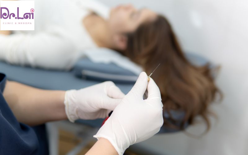 Điều trị sẹo rỗ tại cơ sở uy tín