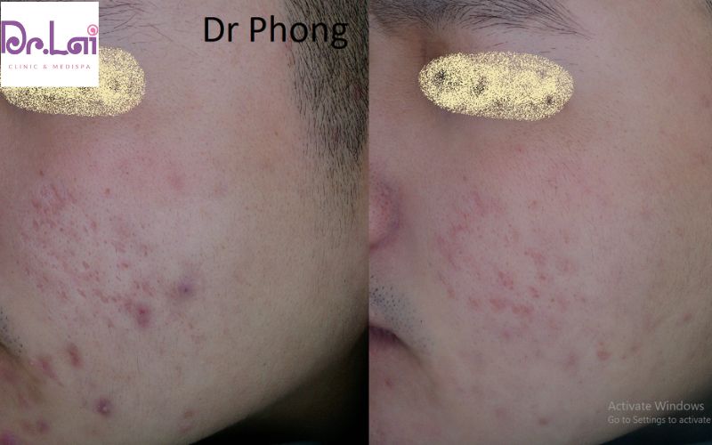 Hình ảnh bên phải mặt khách nam điều trị sẹo rỗ tại Dr. Lai