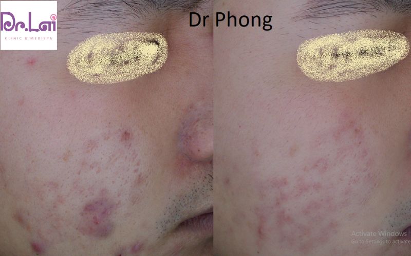 Hình ảnh bên trái mặt khách nam điều trị sẹo rỗ tại Dr. Lai
