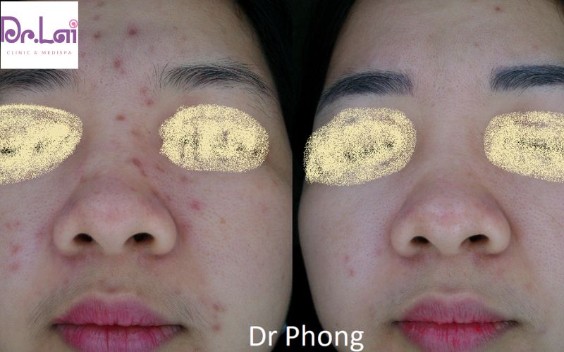 Cải thiện sẹo rỗ sau 1 liệu trình
